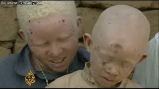 Albino Africans Hunted For Body Parts