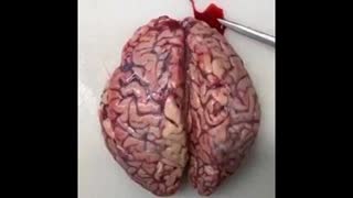 What Does Thromboses in the Brain Due to the 'Clot Shot' Look Like? Apparently From Such an Autopsy