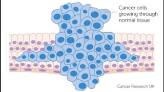 Cancer Research into Interstitium which is a New Found Human Body Organ