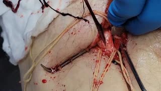 COVID vaccine blood clots: video from embalmer Richard Hirschman