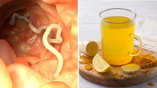 6 Home Remedies to Get Rid of Intestinal Worms