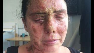 Brian Ruhe - Muslims Commit Acid Attacks In Britain