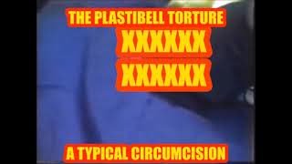 What You Should Know About Plastibell Circumcision