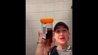 BLACK URINE and other problems After 2 Pfizer COVID SHOTS