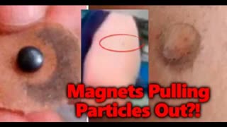 Magnet pulling particles (nano bots? graphene oxide?) out of the vaxx area on a mans arm