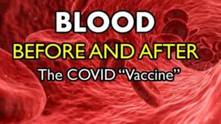 Vetted Images - Blood Before and After the mRNA COVID "Vaccine" Shot (Think Blood Clots)