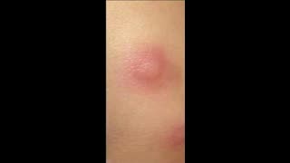 GMO Mosquito Bite In Texas leaves huge welp on lady's arm (this is not normal but what is lately?)